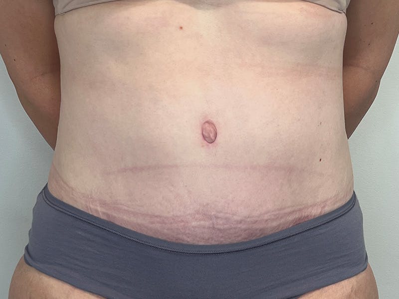 Tummy Tuck Before & After Gallery - Patient 248539 - Image 2