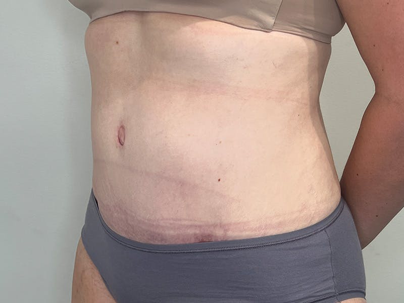 Tummy Tuck Before & After Gallery - Patient 248539 - Image 4
