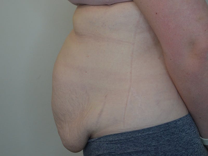 Tummy Tuck Before & After Gallery - Patient 248539 - Image 5