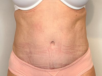 Tummy Tuck Before & After Gallery - Patient 149807 - Image 2