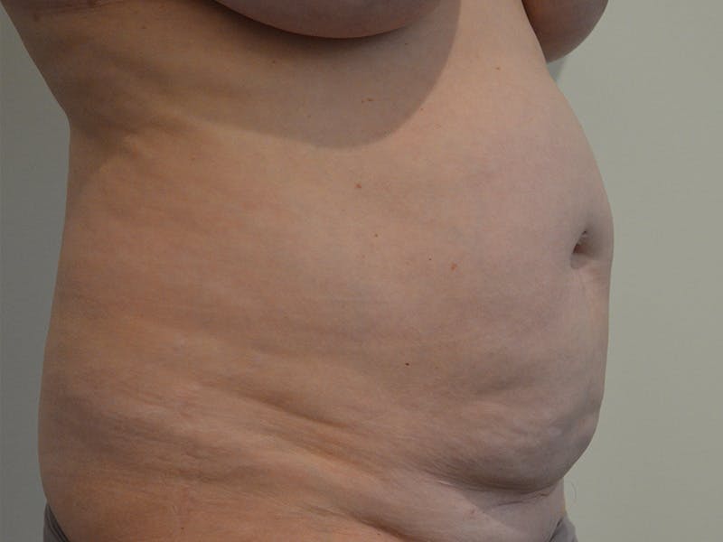 Tummy Tuck Before & After Gallery - Patient 149807 - Image 3