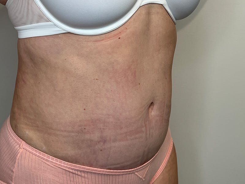 Tummy Tuck Before & After Gallery - Patient 149807 - Image 4