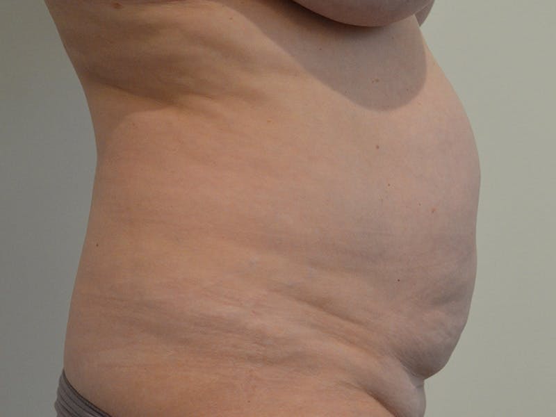 Tummy Tuck Before & After Gallery - Patient 149807 - Image 5
