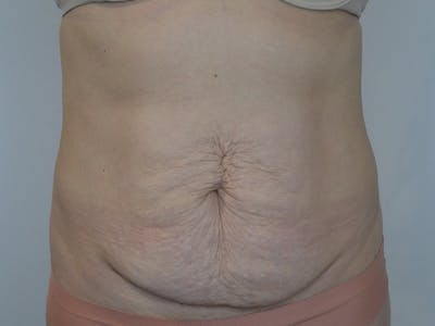 Tummy Tuck Before & After Gallery - Patient 680849 - Image 1
