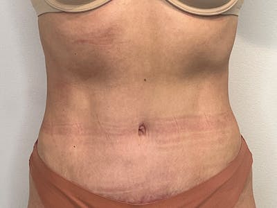 Tummy Tuck Before & After Gallery - Patient 680849 - Image 2