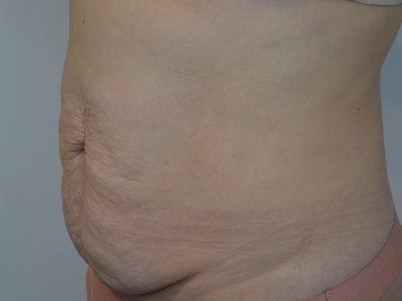 Tummy Tuck Before & After Gallery - Patient 680849 - Image 3