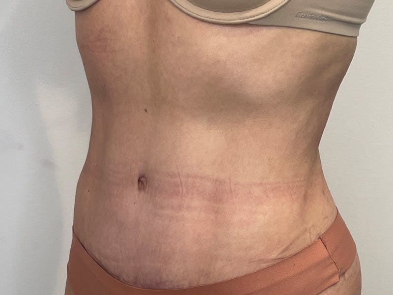 Tummy Tuck Before & After Gallery - Patient 680849 - Image 4