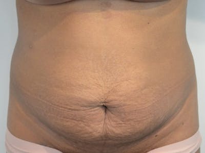 Tummy Tuck Before & After Gallery - Patient 876781 - Image 1