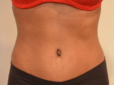 Tummy Tuck Before & After Gallery - Patient 876781 - Image 2