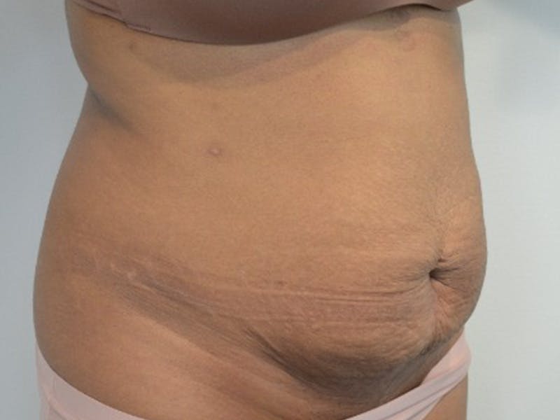Tummy Tuck Before & After Gallery - Patient 876781 - Image 3