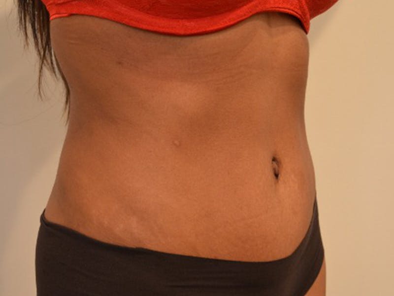 Tummy Tuck Before & After Gallery - Patient 876781 - Image 4