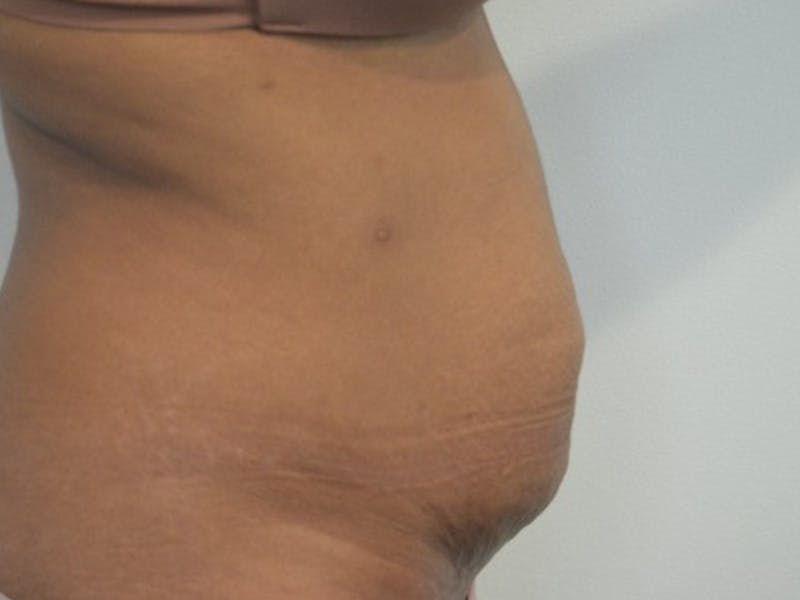 Tummy Tuck Before & After Gallery - Patient 876781 - Image 5
