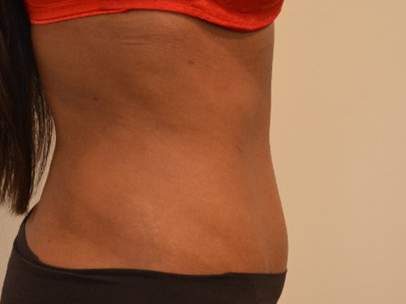 Tummy Tuck Before & After Gallery - Patient 876781 - Image 6