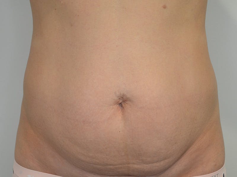 Tummy Tuck Before & After Gallery - Patient 247096 - Image 1