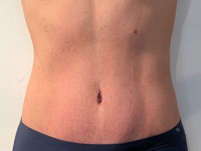 Tummy Tuck Before & After Gallery - Patient 247096 - Image 2