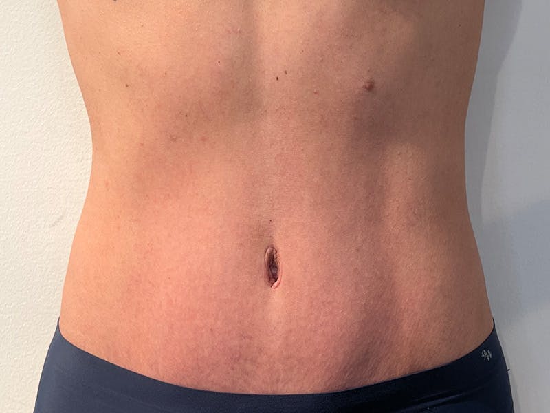 Tummy Tuck Before & After Gallery - Patient 247096 - Image 2