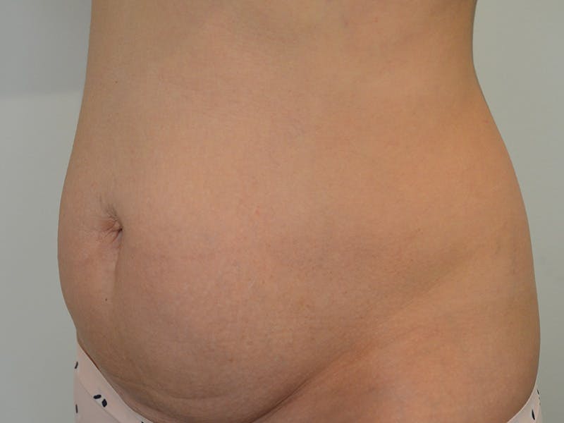 Tummy Tuck Before & After Gallery - Patient 247096 - Image 3