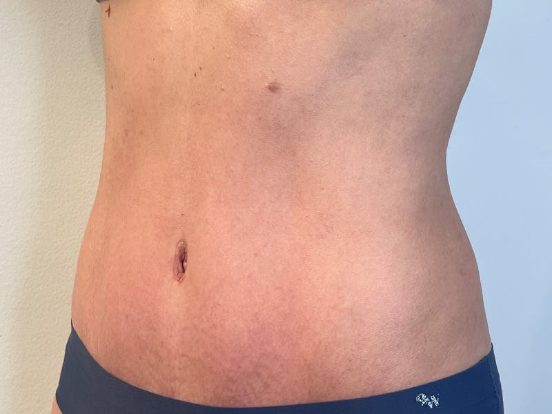 Tummy Tuck Before & After Gallery - Patient 247096 - Image 4