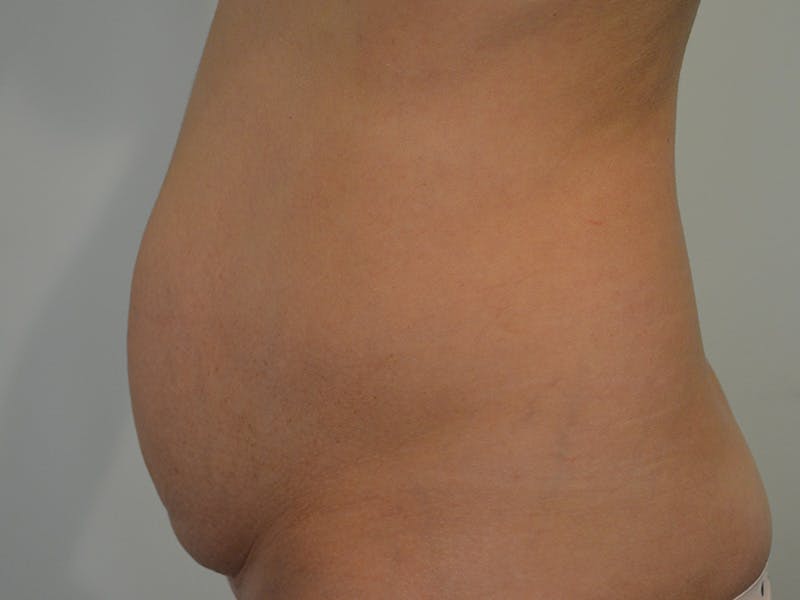 Tummy Tuck Before & After Gallery - Patient 247096 - Image 5