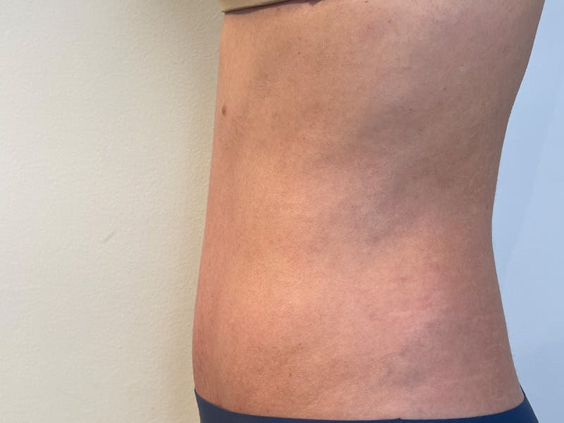Tummy Tuck Before & After Gallery - Patient 247096 - Image 6