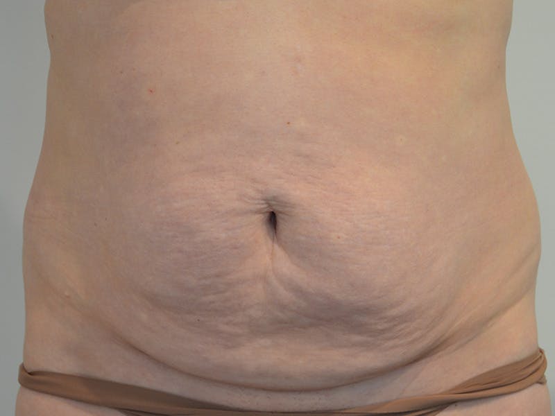 Tummy Tuck Before & After Gallery - Patient 146701 - Image 1
