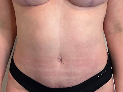 Tummy Tuck Before & After Gallery - Patient 146701 - Image 2
