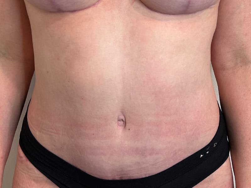 Tummy Tuck Before & After Gallery - Patient 146701 - Image 2