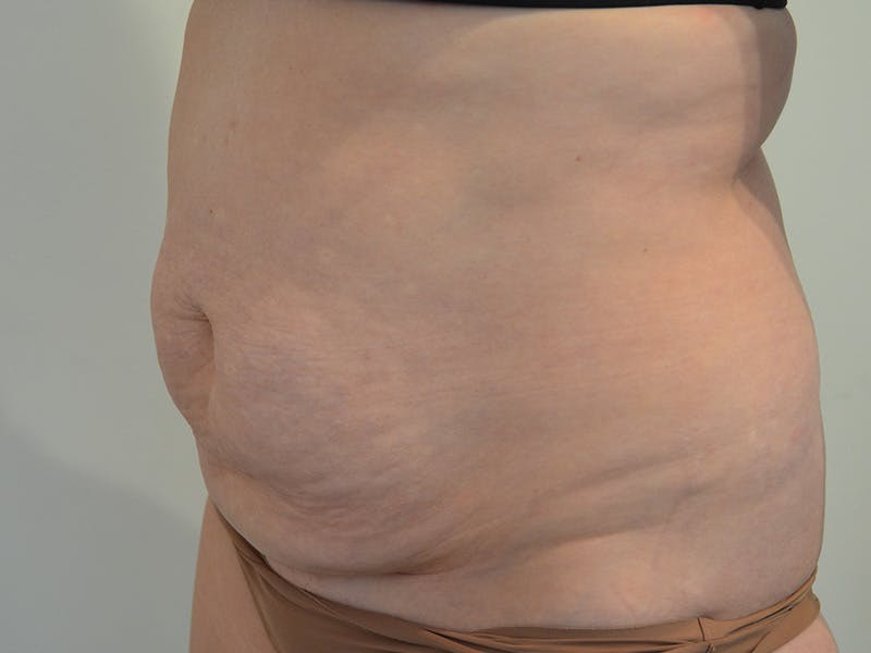 Tummy Tuck Before & After Gallery - Patient 146701 - Image 3