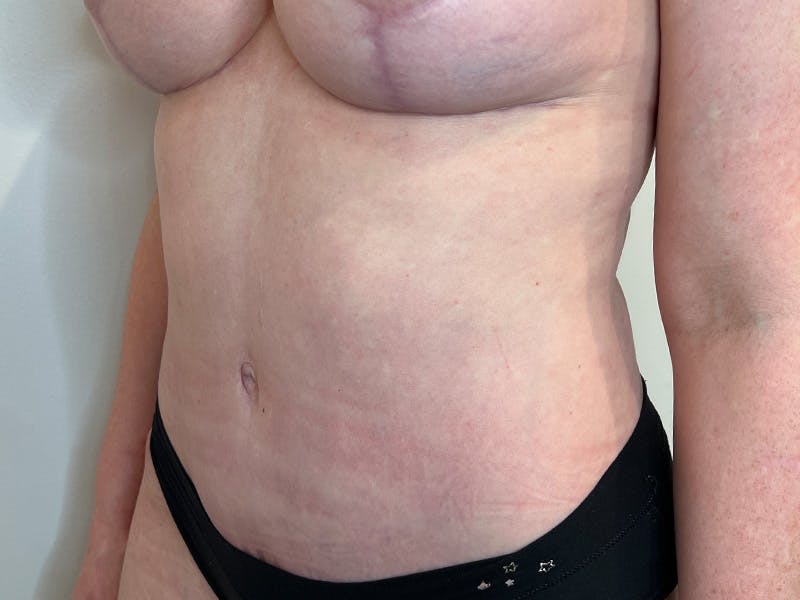 Tummy Tuck Before & After Gallery - Patient 146701 - Image 4