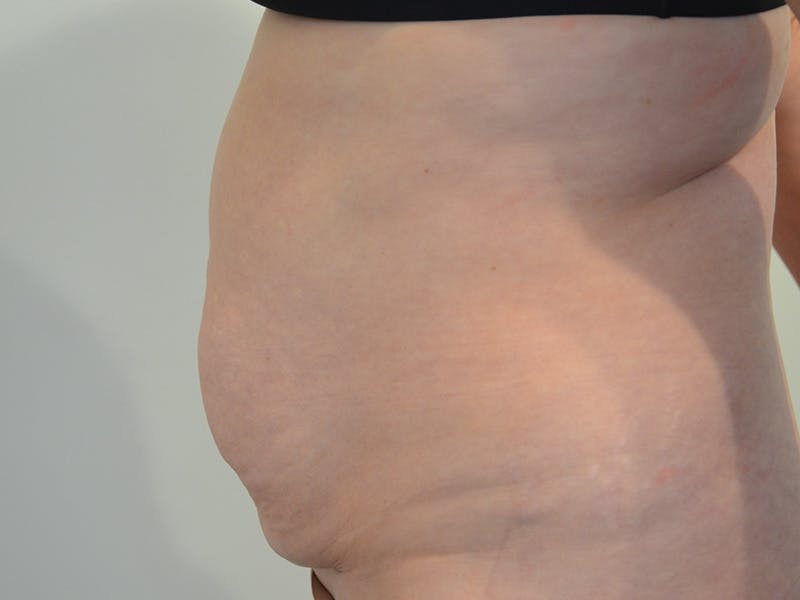 Tummy Tuck Before & After Gallery - Patient 146701 - Image 5