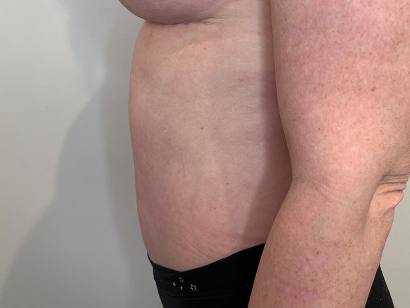 Tummy Tuck Before & After Gallery - Patient 146701 - Image 6