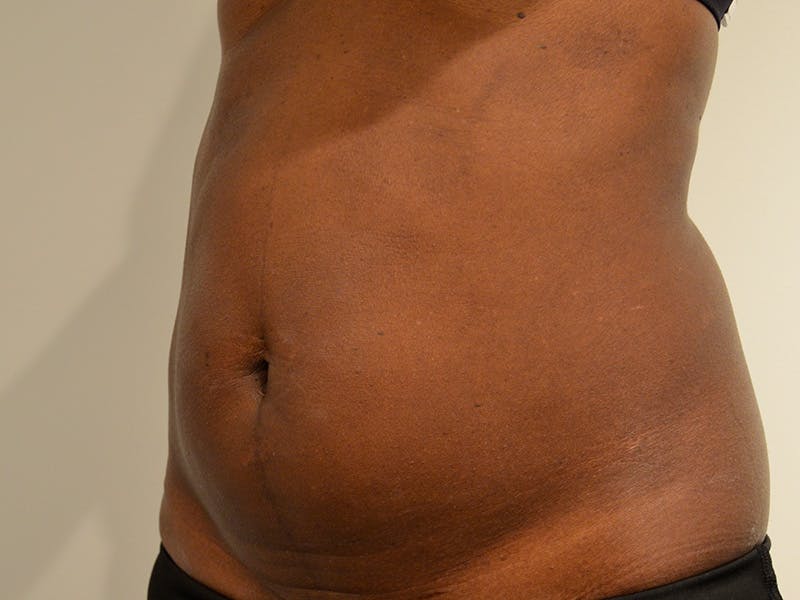 Tummy Tuck Before & After Gallery - Patient 361095 - Image 3