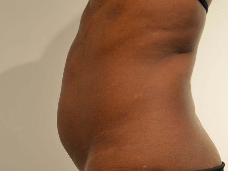 Tummy Tuck Before & After Gallery - Patient 361095 - Image 5
