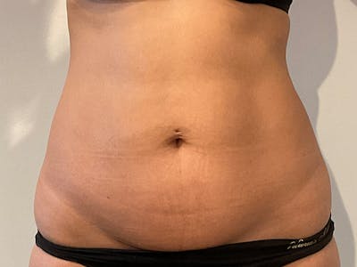 Tummy Tuck Before & After Gallery - Patient 870689 - Image 1