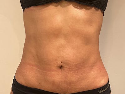 Tummy Tuck Before & After Gallery - Patient 870689 - Image 2