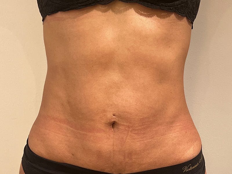 Tummy Tuck Before & After Gallery - Patient 870689 - Image 2