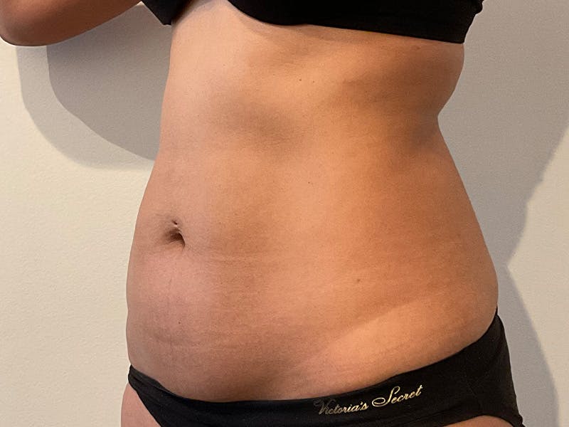 Tummy Tuck Before & After Gallery - Patient 870689 - Image 3