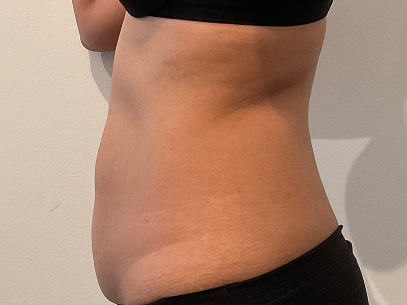 Tummy Tuck Before & After Gallery - Patient 870689 - Image 5