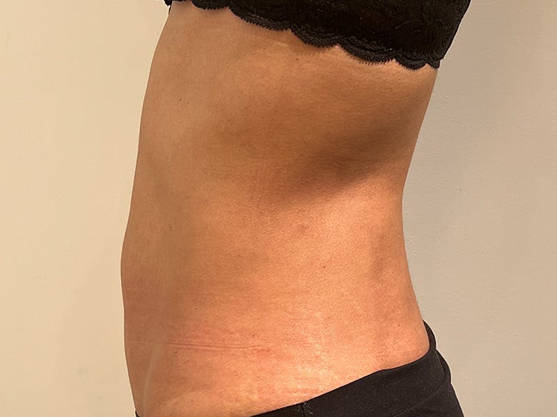 Tummy Tuck Before & After Gallery - Patient 870689 - Image 6