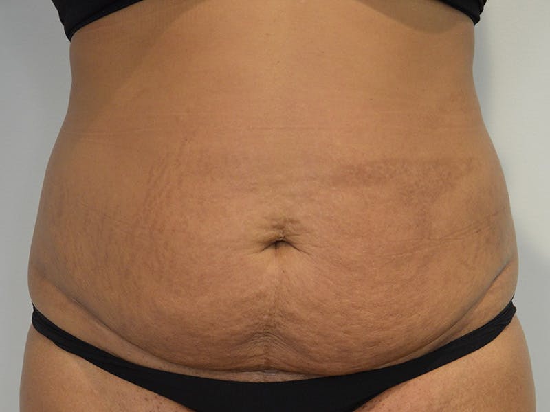 Tummy Tuck Before & After Gallery - Patient 267129 - Image 1
