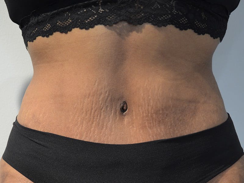 Tummy Tuck Before & After Gallery - Patient 267129 - Image 2