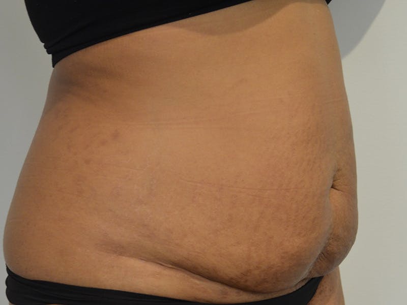 Tummy Tuck Before & After Gallery - Patient 267129 - Image 3