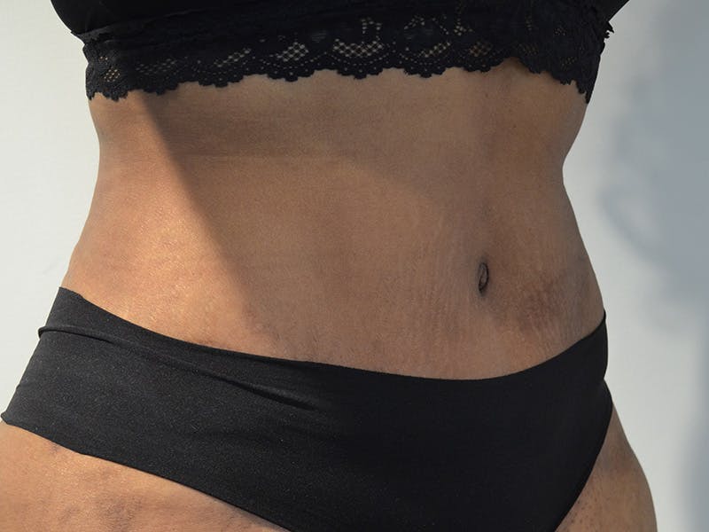 Tummy Tuck Before & After Gallery - Patient 267129 - Image 4