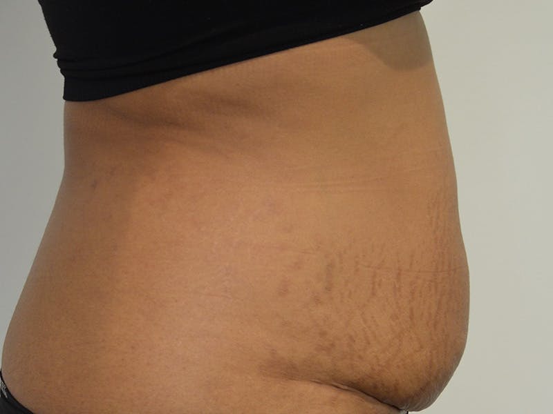 Tummy Tuck Before & After Gallery - Patient 267129 - Image 5