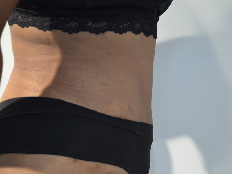 Tummy Tuck Before & After Gallery - Patient 267129 - Image 6