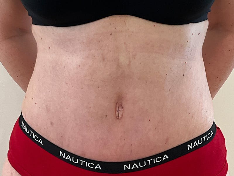 Tummy Tuck Before & After Gallery - Patient 339645 - Image 2