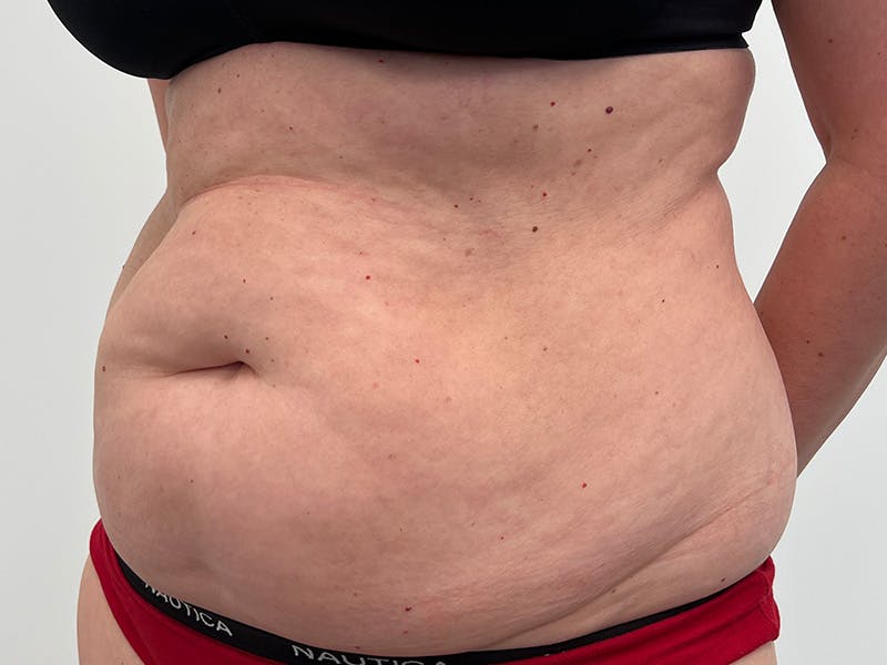 Tummy Tuck Before & After Gallery - Patient 339645 - Image 3