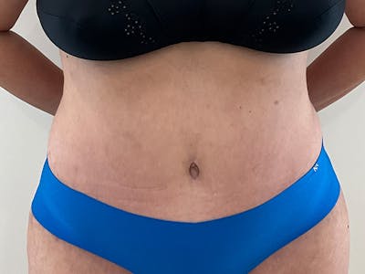 Tummy Tuck Before & After Gallery - Patient 318633 - Image 2