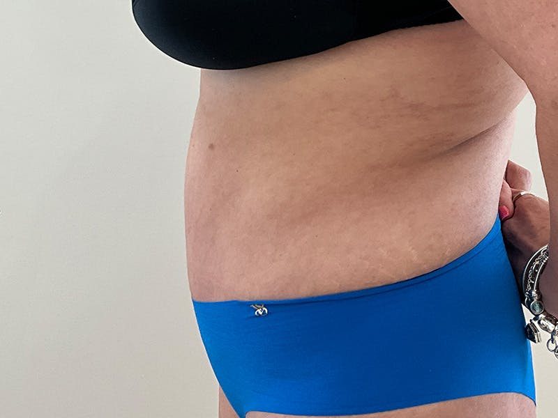 Tummy Tuck Before & After Gallery - Patient 318633 - Image 6