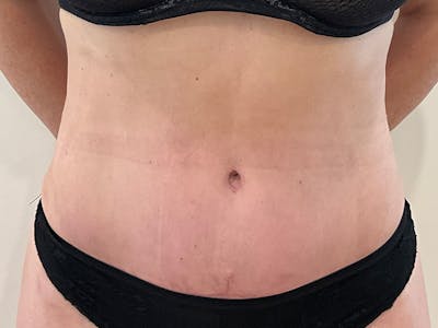 Tummy Tuck Before & After Gallery - Patient 288482 - Image 2